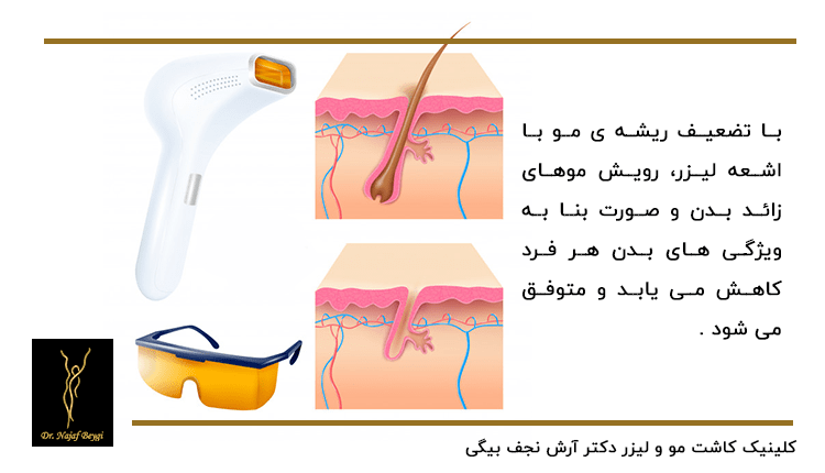 دستگاه لیزر دستی که باعث تضعیف ریشه های مو و توقف رشد موهای زائد بدن می شود