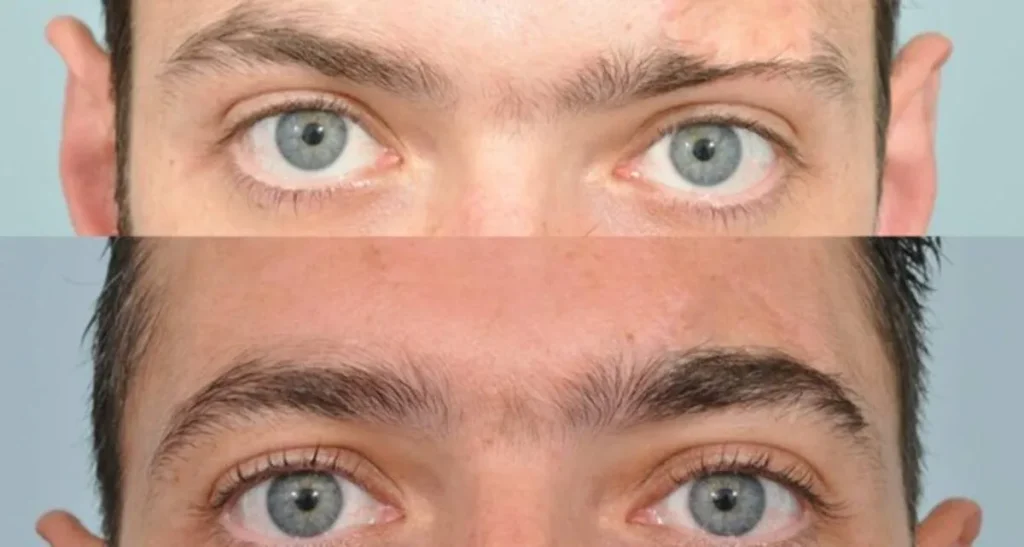 کاشت ابرو برای آقایان