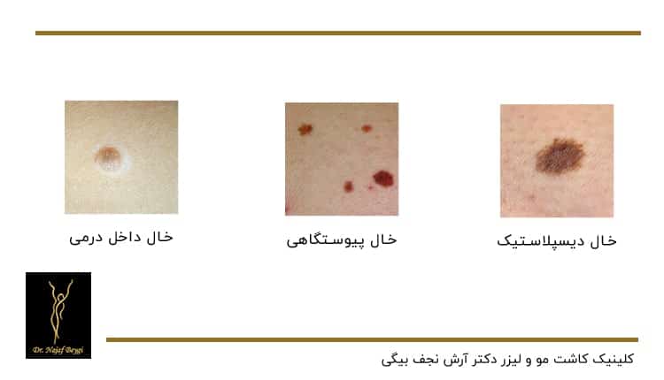 انواع مختلف خالها