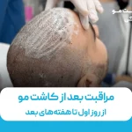 مراقبت بعد از کاشت مو