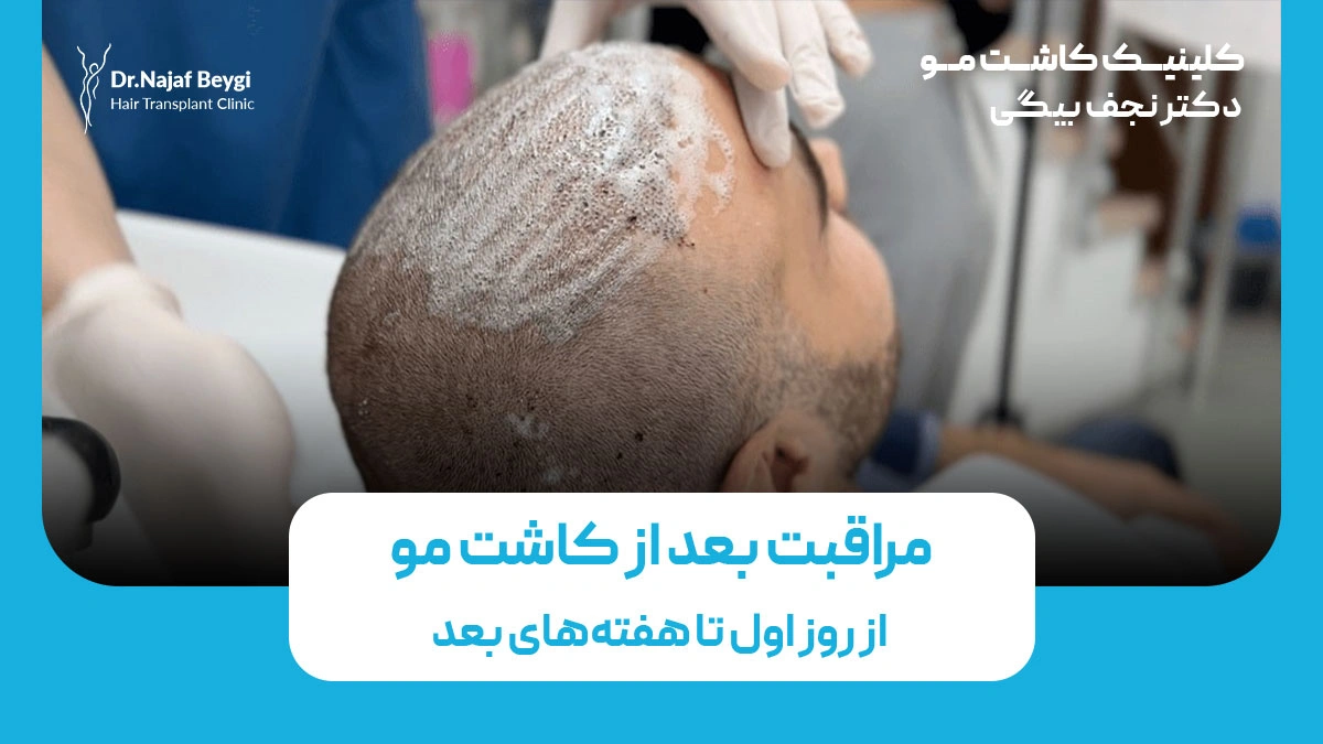 مراقبت بعد از کاشت مو