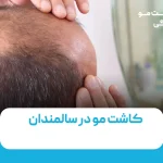 ریزش مو بعد از کاشت مو