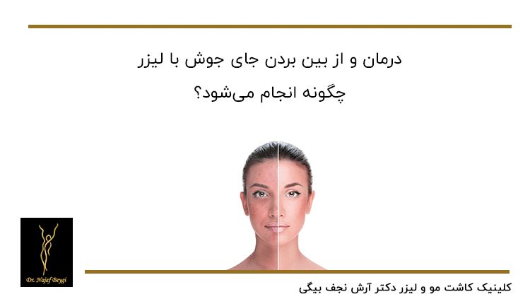 روش از بین بردن جوش با لیزر