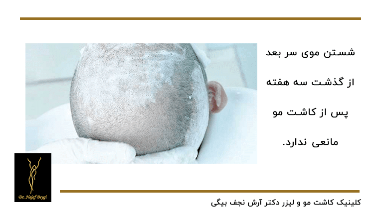 شست و شوی سر بعد از کاشت مو از مرقبت های مهم بعد از عمل کاشت مو