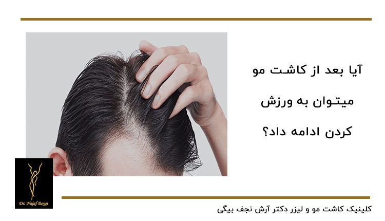 ورزش کردن بدون منع بعد از عمل کاشت مو