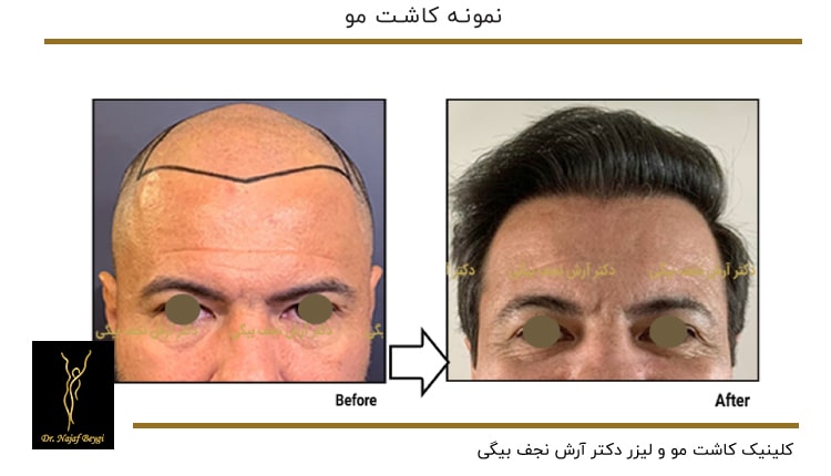 تاثیرات کاشت مو