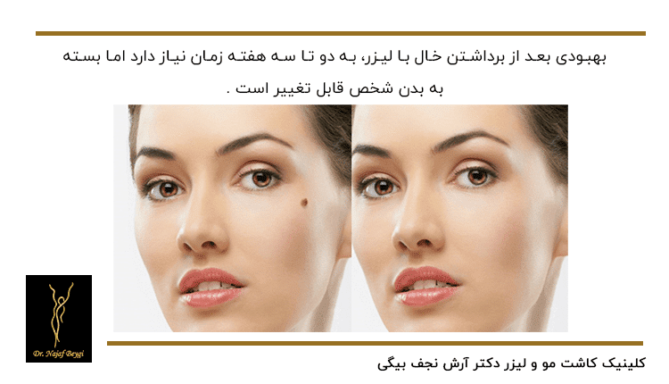 برداشتن خال با لیزر