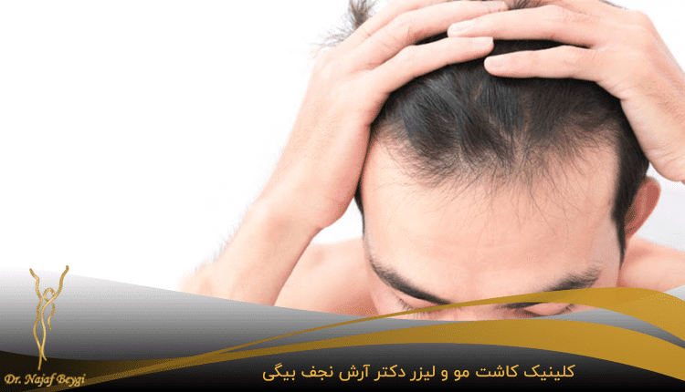 کاشت مو به روش FUT در کلینیک دکتر نجف بیگی