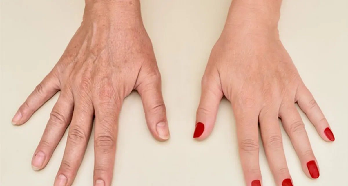 جوانسازی پوست دست ها و رفع چین و چروک