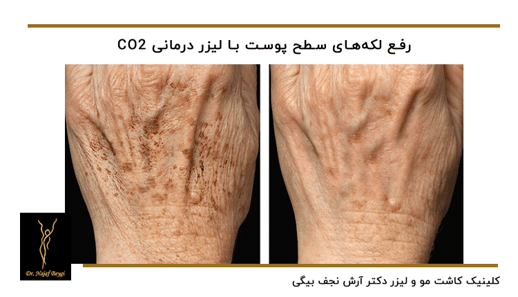 قبل و بعد از درمان لک های روی دست برای جوانسازی دست ها
