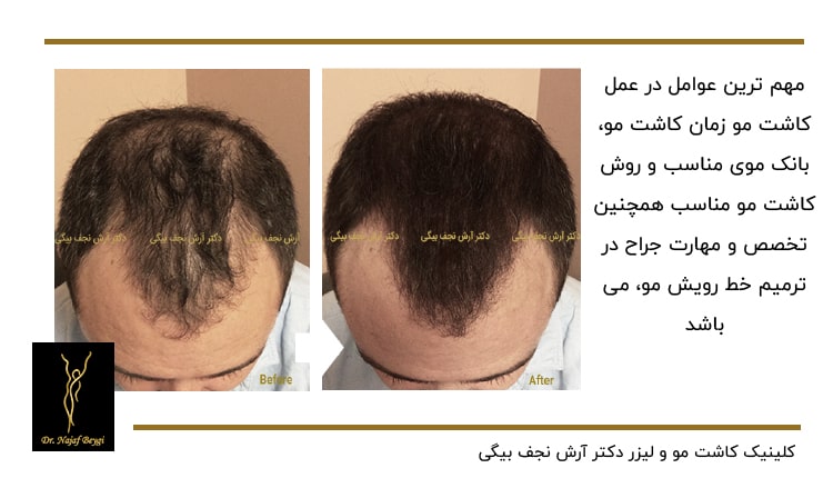 نمونه قبل و بعد از کاشت مو