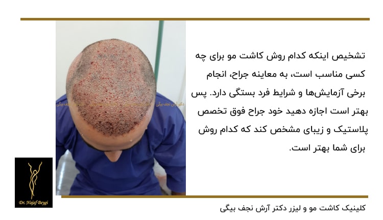 کاشت مو