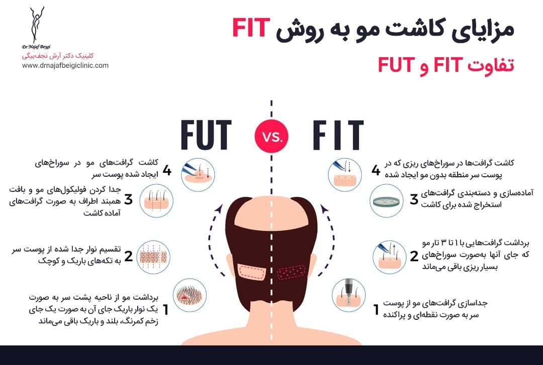 مزایای کاشت مو به روش FIT