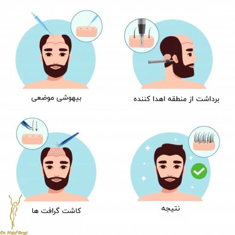 مراحل کاشت مو