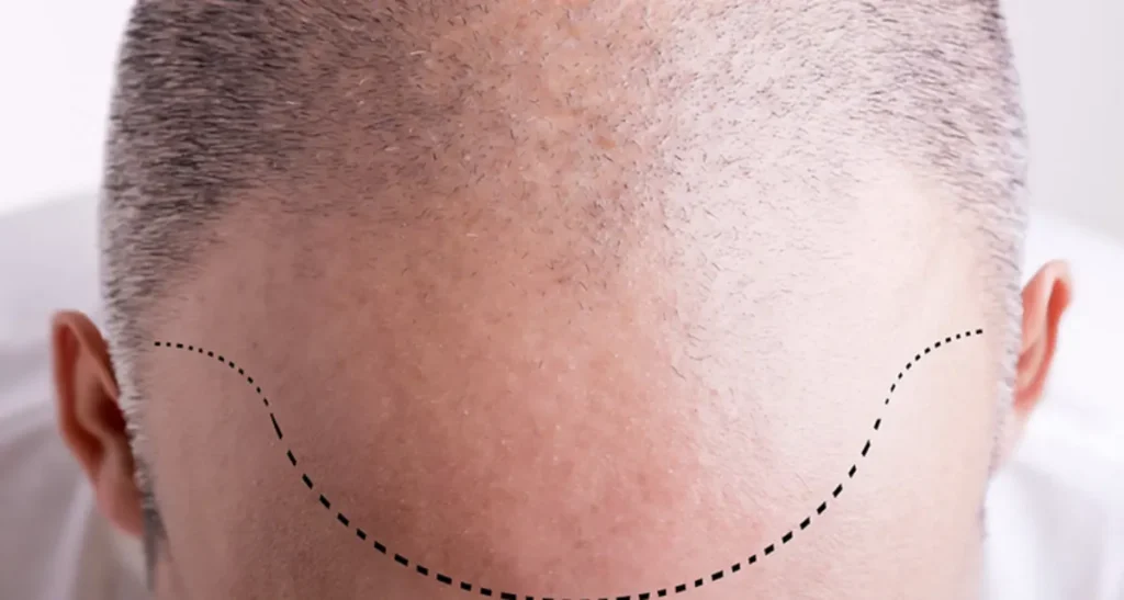 عوامل مؤثر بر تراکم کاشت مو