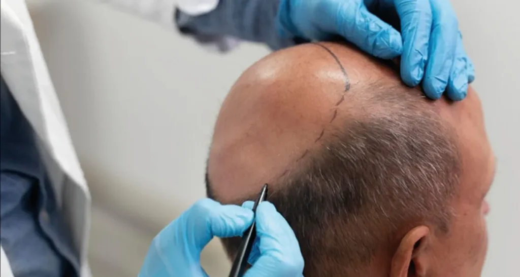 معرفی بهترین روش کاشت مو با تراکم بالا