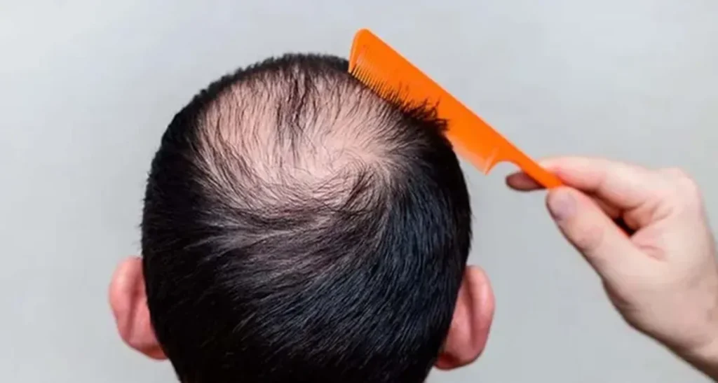 کاشت مو پرتراکم