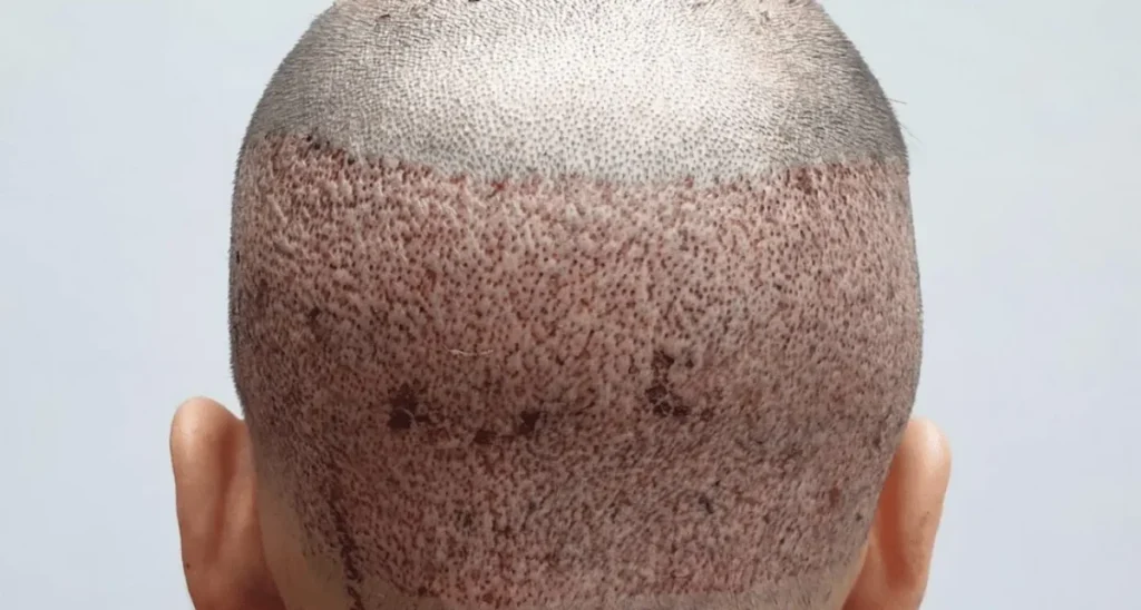 کاشت مو پر تراکم