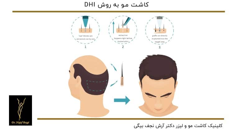 مراحل کاشت مو به روش DHI