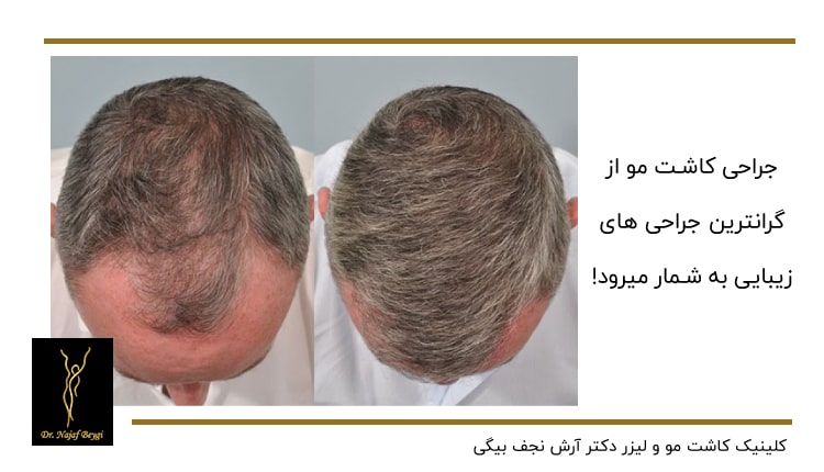نمونه تاثیرات کاشت مو