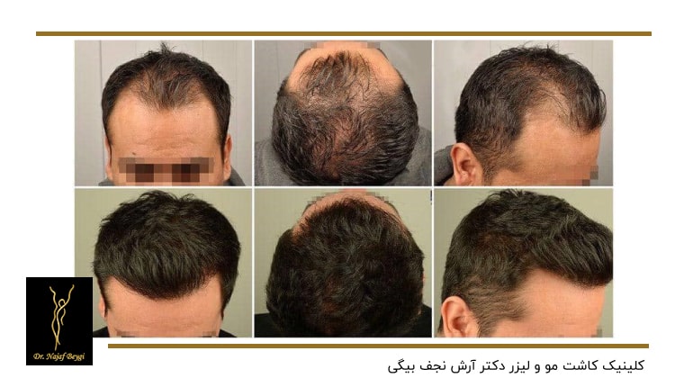 نتایج کاشت مو