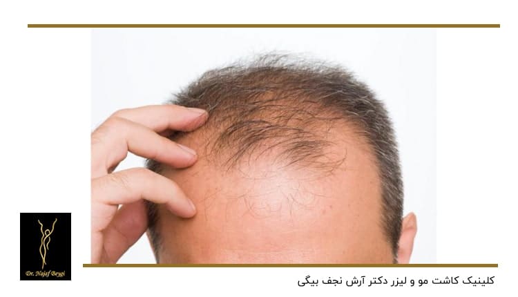کردی که دچار ریزش مو شده