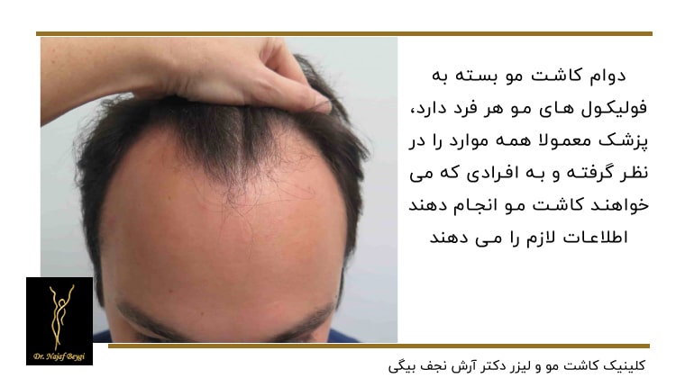 دوام کاشت مو بسته به فولیکول مو دارد