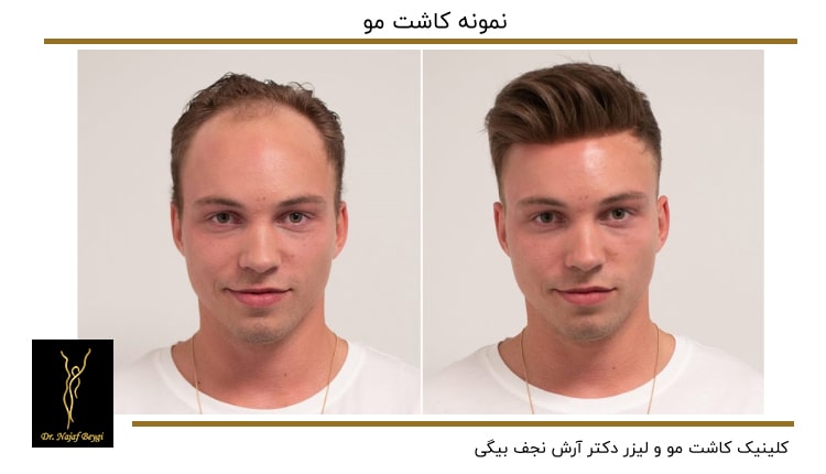 نمونه قبل و بعد از کاشت مو