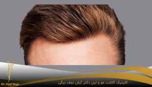 بالاترین تراکم کاشت مو چقدر است؟