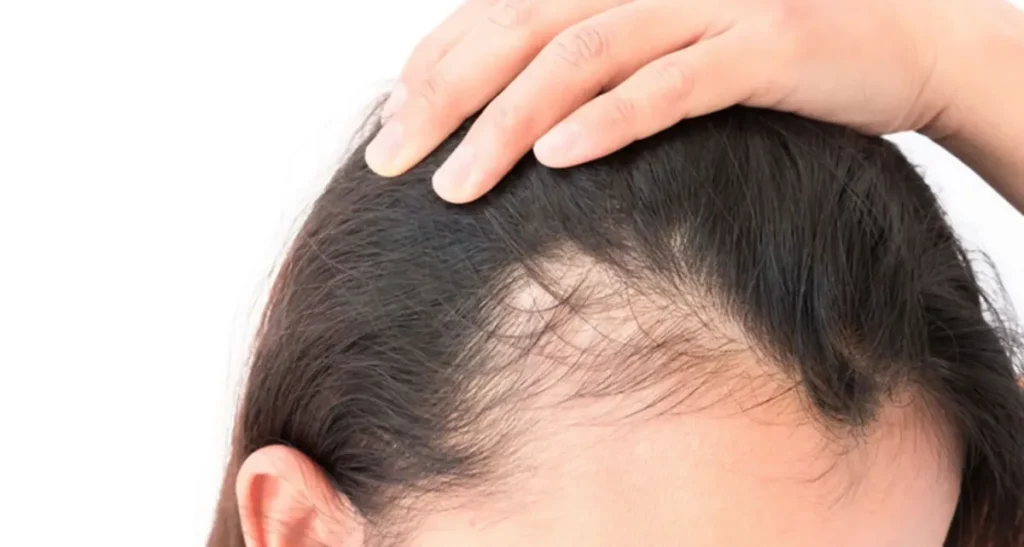 معجزه پیوند مو با ایمپلنت