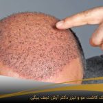 موهای کاشته شده بر روی صورت