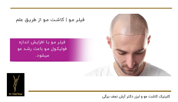 نمونه تاثیر فیلر مو بر سر