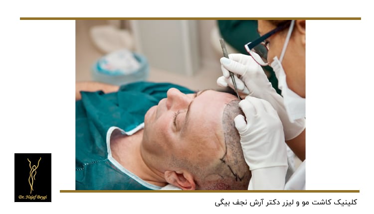 کاشت مو بر روی سر توسط دکتر متخصص