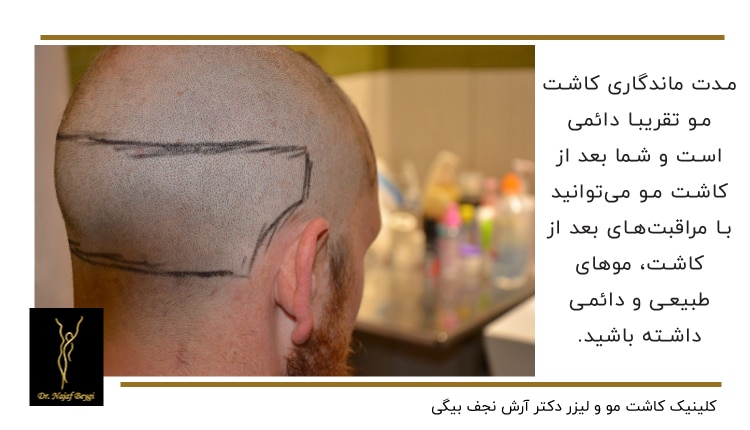 مدت ماندگاری کاشت مو
