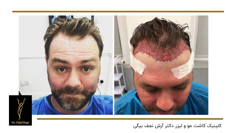 نمونه قبل وب بعد از ایمپلنت موی سر