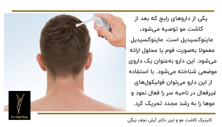 استفاده از ماینوکسیدیل برای موی سر