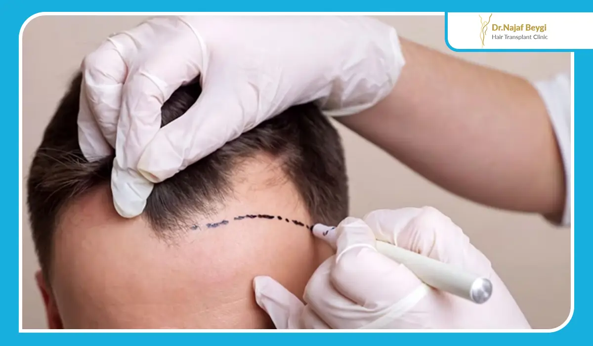 چگونه برای انجام ایمپلنت مو اقدام کنید؟