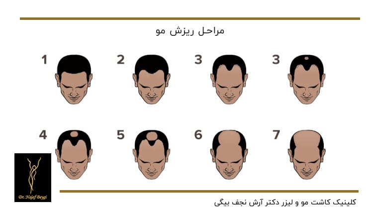 مراحل ریزش مو