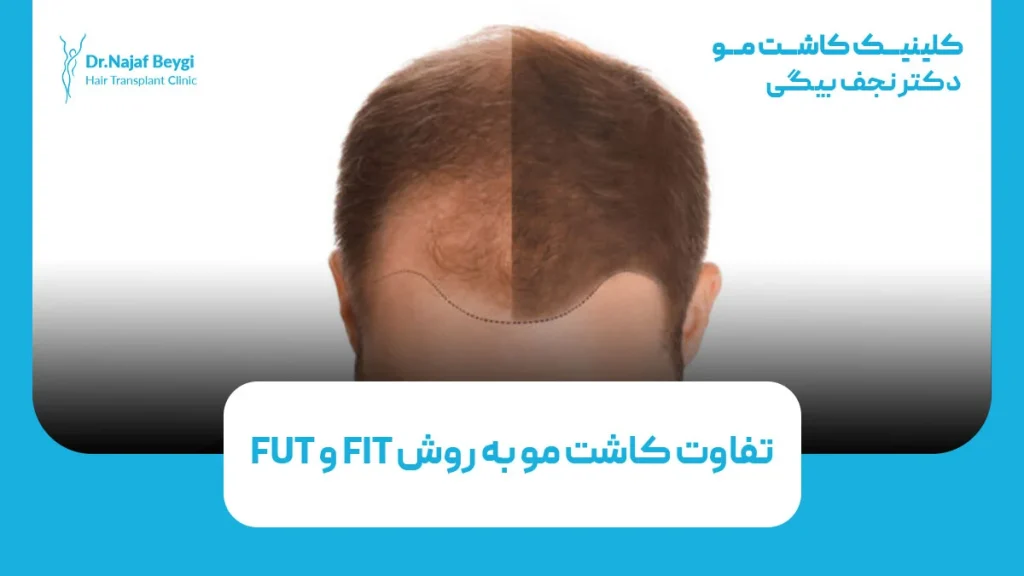 تفاوت کاشت مو به روش FIT و FUT