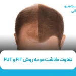 تفاوت کاشت مو به روش FIT و FUT