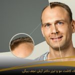 تاثیر پیوند ریش به مو