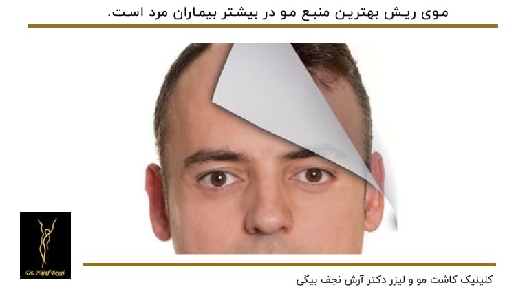 موی ریش بهترین منبع مو در بیماران مرد