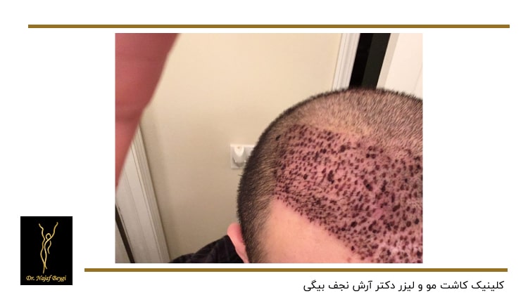 زخم های بعد از کاشت مو