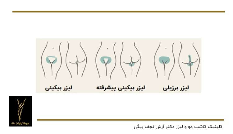 انواع لیزر بیکینی