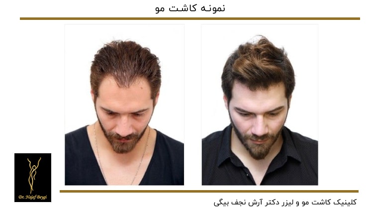 نمونه کاشت مو
