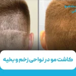 کاشت مو در نواحی زخم و بخیه