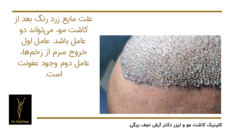 علت مایع زرد رنگ بعد کاشت مو