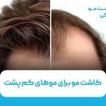 کاشت مو برای موهای کم پشت