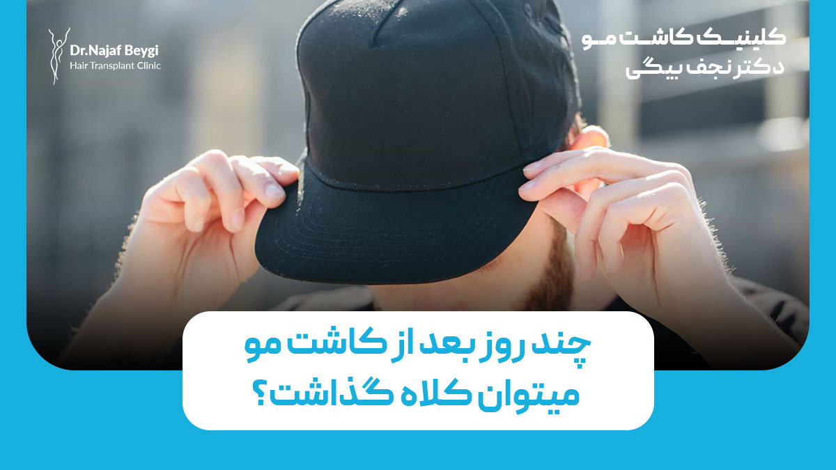 چند روز بعد از کاشت مو میتوان کلاه گذاشت