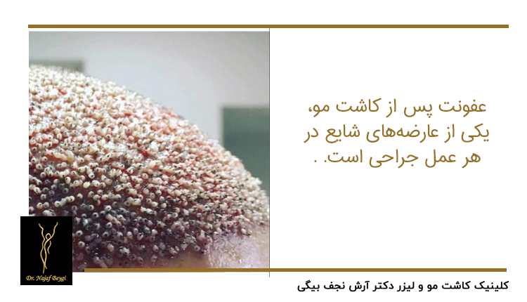 عفونت بعد از کاشت